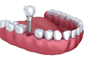 dental implants great yarmouth