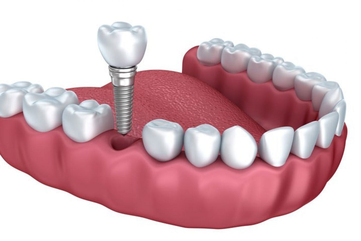 dental implants Dentist Great Yarmouth and Lowestoft